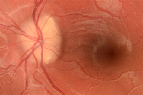 Optic Disc Drusen And Pseudo Papilloedema Eyeonoptics