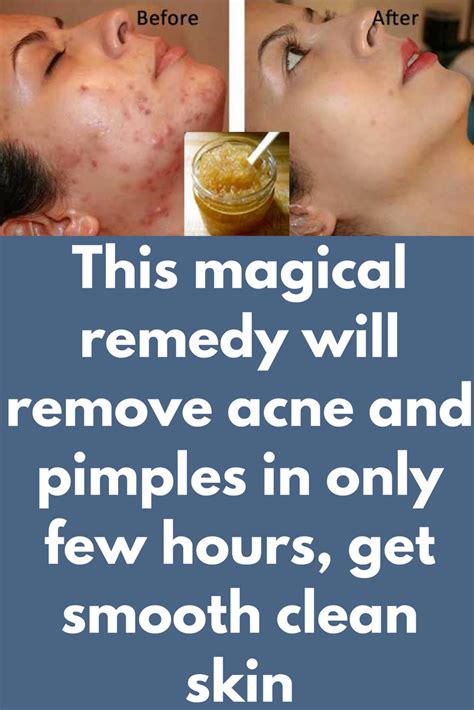 This Magical Remedy Will Remove Acne And Pimples In Only Few Hours Get Smooth Clean Skin Pimple
