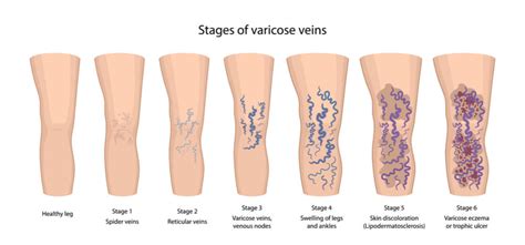 Varicose Veins Metro Atlanta Vein Disease Alpharetta Heart And Vascular