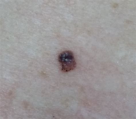 Melanoma With Comedo Like Openings A Rare Dermoscopic Finding