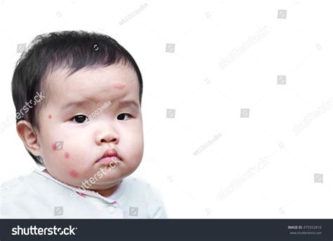 Baby Face Mosquito Bites Isolated Space Stock Photo 475552816