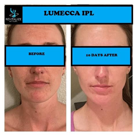 Before And After Gallery Lumecca Revitalize Medspa