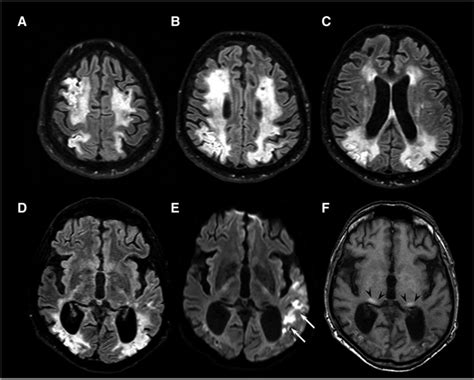 Brain Mri In A 55 Year Old Male Fabry Patient Gla Variant P