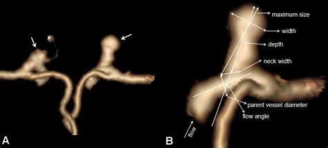 Morphological Characteristics Associated With The Rupture Risk Of Mirror Posterior Communicating