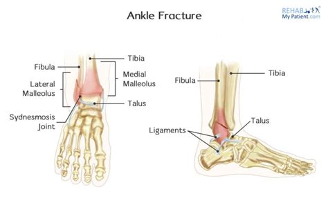 Ankle Sprain Vs Fracture Treatment Cawley Physical Therapy
