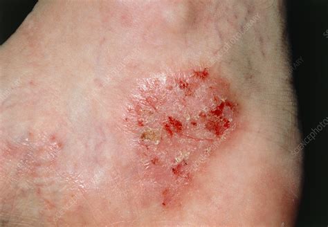 Dermatophyte Fungal Infection Of Skin On Foot Stock Image M2700115