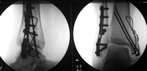 Bimalleolar fracture - Wikipedia