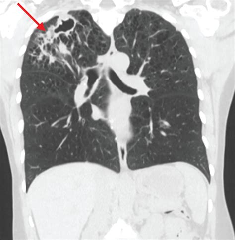A Case Of Lung Cancer Originating From Cavitary Mycobacterium Xenopi