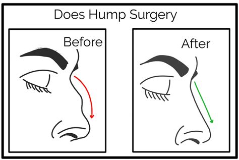 Dorsal Hump Nose Treatment A Complete Guide 101