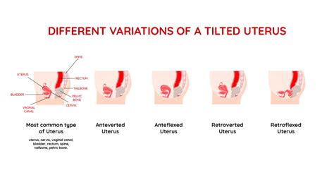 The Best Menstrual Cup For A Tilted Uterus And How To Use It