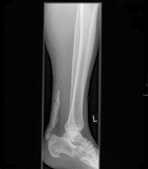 Achilles Tendon Ossification Image