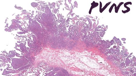 Pvns Pigmented Villonodular Synovitis Tenosynovial Giant Cell Tumor