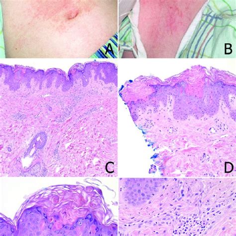 Clinical And Biopsy Findings From Patient 3 Persistent Erythematous