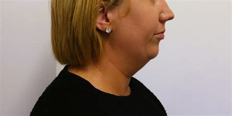 Double Chin Neck Jawline Liposuction Vaser Lipo Renuvion Plasma 2 Dr