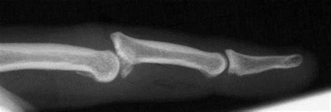 Phalanx Dislocations Hand Orthobullets