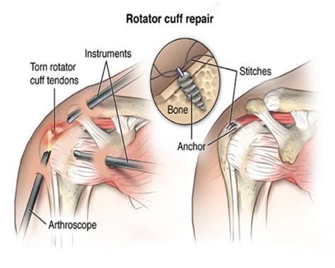 Arthroscopic Rotator Cuff Repair Dr Lingaraju