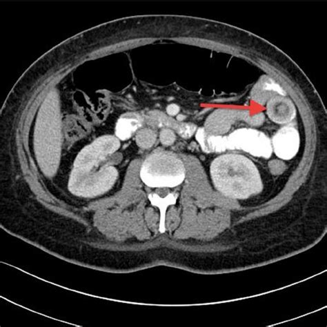 A Ct Scan Of The Abdomen Transverse Section Showing Small Bowel