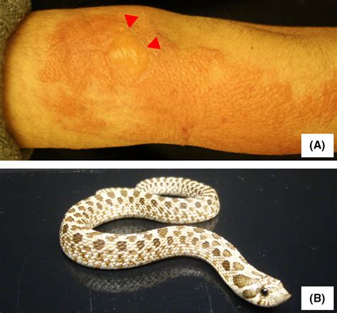 A Case Of Western Hognose Snake Bite Kato 2019 Journal Of