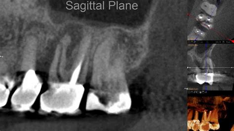 Fracture In An Endodontically Treated Upper Molar Cbct Scan Youtube