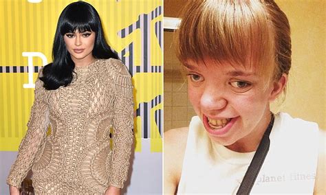 woman with genetic disorder and kylie jenner launch anti bullying campaign