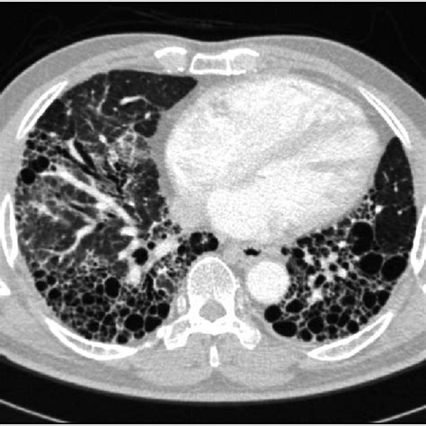 Preoperative Chest Computed Tomography Subpleural And Download