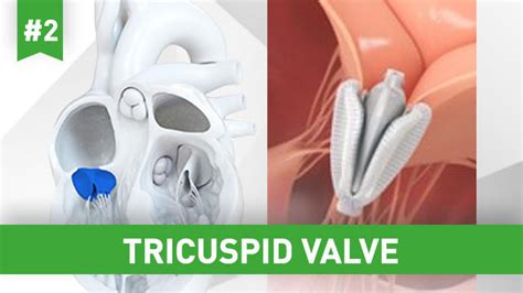 How Should We Use Transcatheter Tricuspid Valve Repair To Treat
