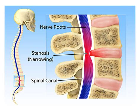 Spinal Stenosis Net Health Book