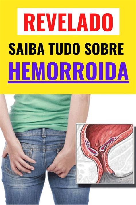 O Que Causa Hemorroida Tudo Sobre Hemorroidas Hemorr Idas