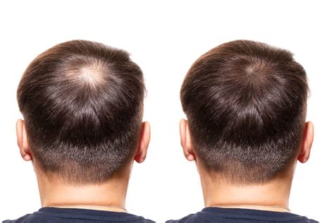 How Do Hair Transplants Work Hair Restoration Procedure