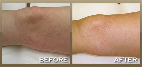 Laser Vein Removal In Los Angeles Skinpeccable