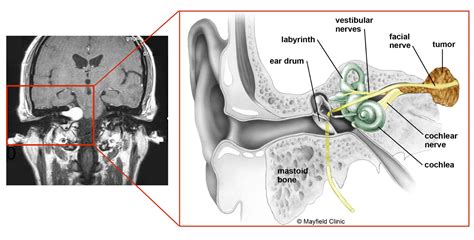 Middle Cranial Fossa Surgery Offers A Better Chance For Hearing