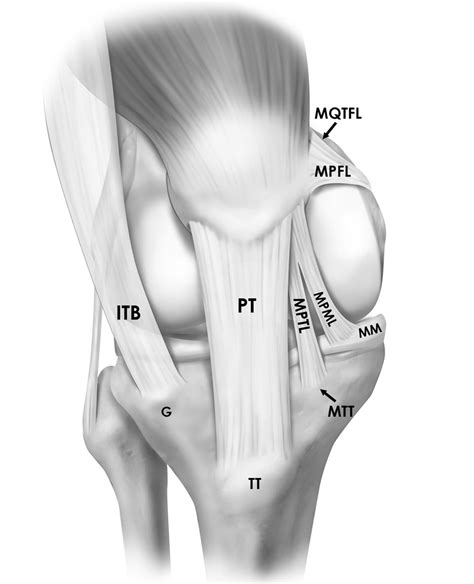 Level Of Medial Patellofemoral Ligament Mpfl Insertion Onto The Femur