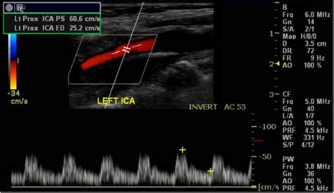 Carotid Ultrasound Quick Reference Guide