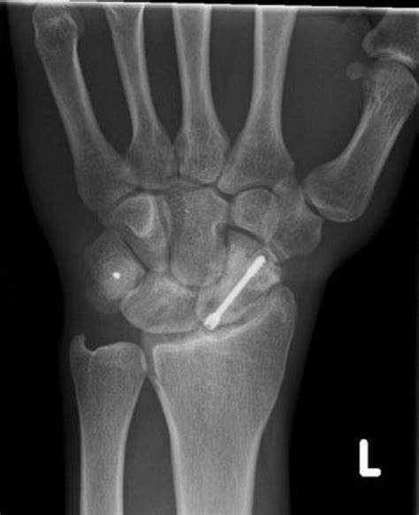 Wrist Pa X Ray At 20 Months Suggesting Scaphoid Fracture Union