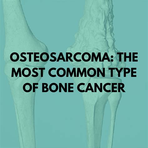 Osteosarcoma The Most Common Type Of Bone Cancer Niruja Healthtech