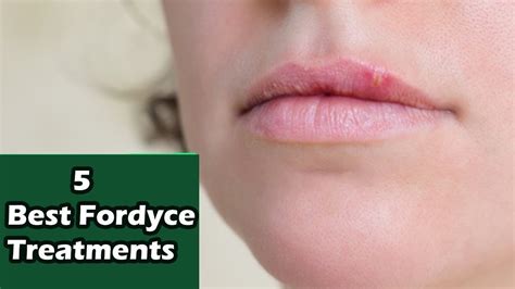 5 Best Fordyce Spots Treatment Fordyce Spots On Lips Fordyce Spots