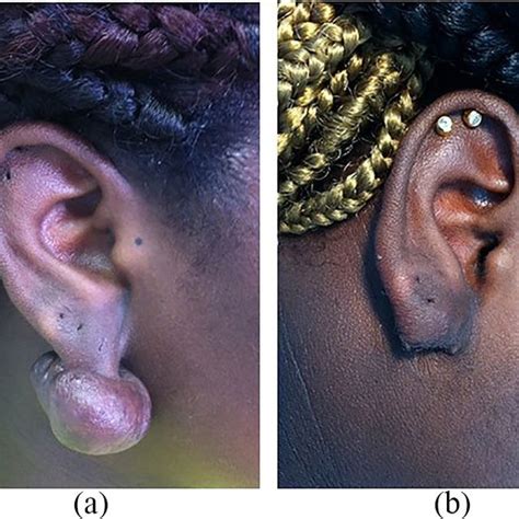Auricular Keloid Surgical Excision Used As Monotherapy Auricular