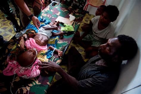 Indonesia Measles Case Malnutrition Not Just A Poor — Malnutrition Deeply