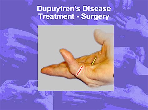 Dupuytrens Disease Hand Surgery Source