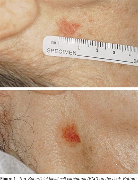 Figure 1 From Treatment Of Superficial Basal Cell Carcinoma And