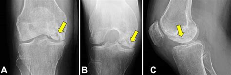 A Anteroposterior B Tunnel And C Lateral Radiographs Of The