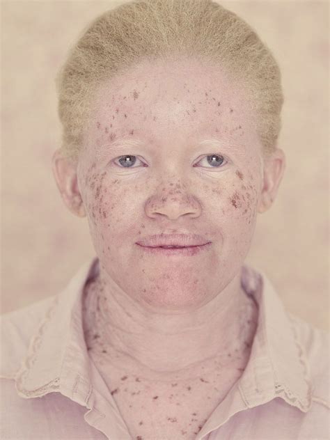 Albinism Gezicht Portret Schoonheid