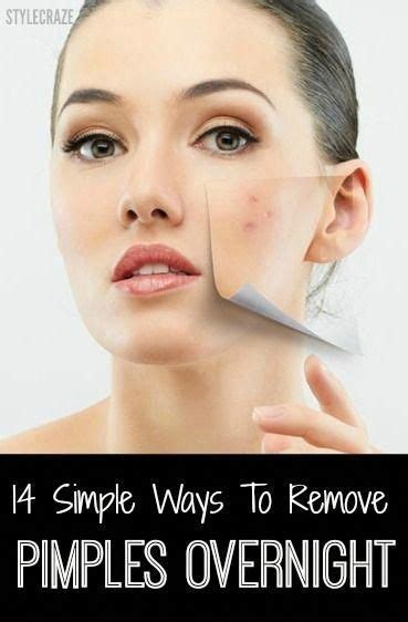 Pin On Pimples Treatment