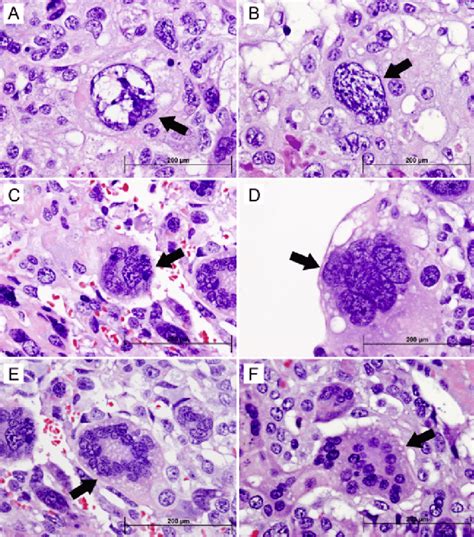 Histologic Images Of Mononucleated Or Multinucleated Giant Cancer Cells