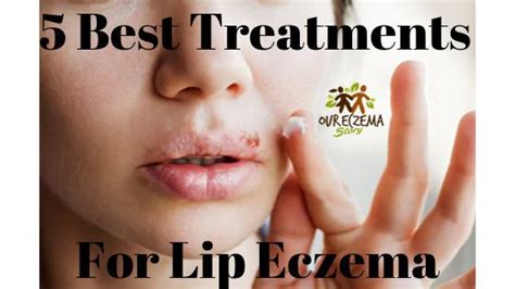 5 Best Treatments For Lip Eczema Eczematous Cheilitis Medicated Lip