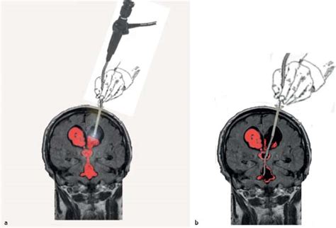 16 Intraventricular Hemorrhage Neupsy Key