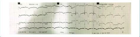 Initial 12 Lead ECG Showing Sinus Rhythm And Widespread Deep T Wave