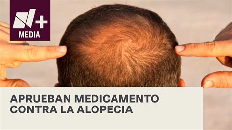 Aprueba Fda Primer Medicamento Contra La Alopecia Bien Y De Buenas