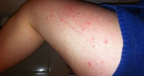 The hiv rash is a symptom of this condition. HIV-Leg-Rashes-1200×638 - Hekim.pro Professional Doctors