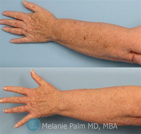 Rash On Arm Treatment Offers Sale Save 62 Jlcatjgobmx